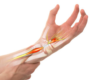 Cum să prevenim sindromul de tunel carpian? Câteva sfaturi și 4 exerciții ușoare Cum să prevenim sindromul de tunel carpian? Câteva sfaturi și 4 exerciții ușoare